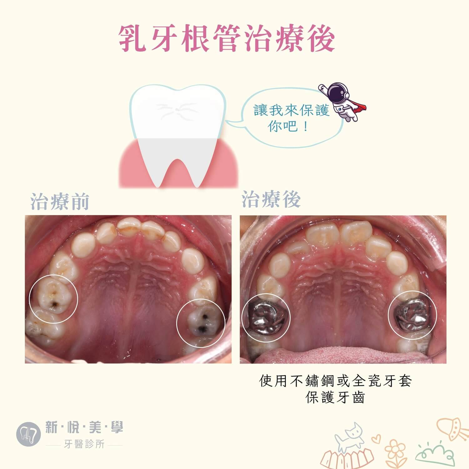 我們家寶貝有蛀牙怎麼辦?的第3張圖片